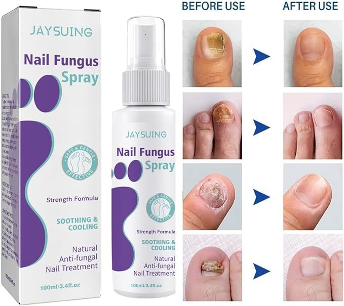 Before and after healthy nail regrowth with fungus spray